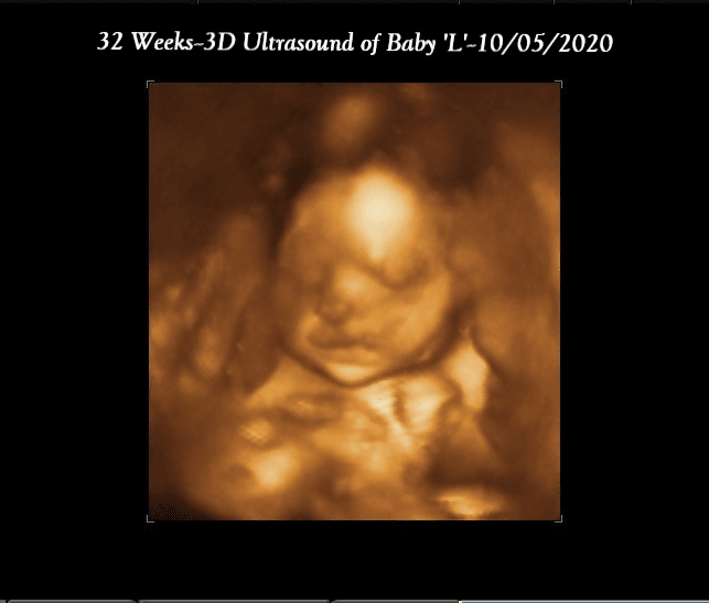 3D ultrasound image of a baby at 32 weeks with the date 10/05/2020 displayed at the top. The baby’s face is partially visible.